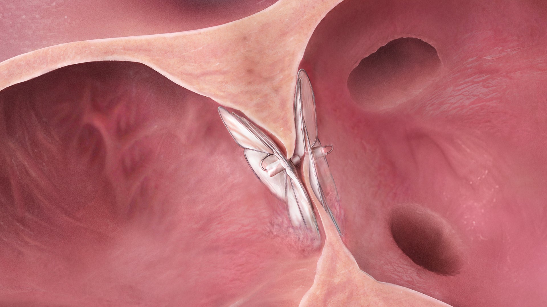 cardiac cardioform septal occluder kasnot