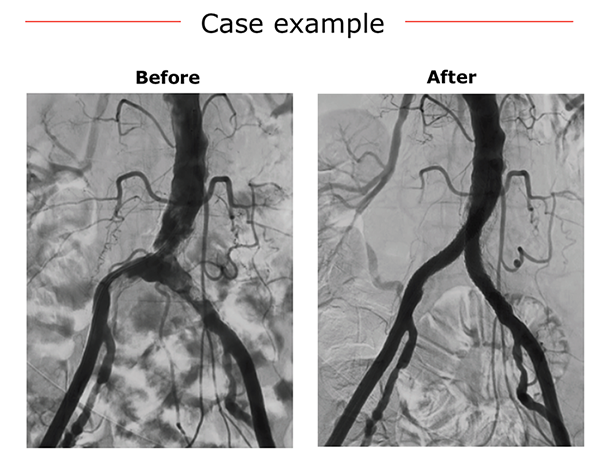 Case example VBX Kissing