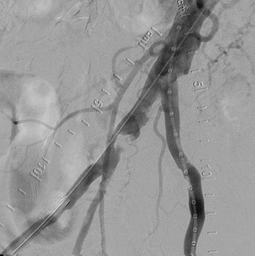 Focal calcification in the right CIA