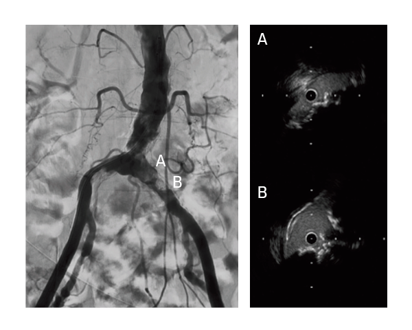 Calcified nodule at the aortoiliac bifurcation