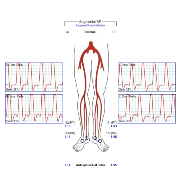 Figure 4. Six-year follow-up ABI. Left = 1.05, Right = 1.14.