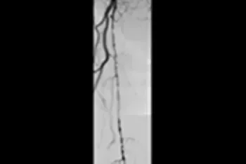 Angiogram of chronic occlusions in superficial femoral artery.