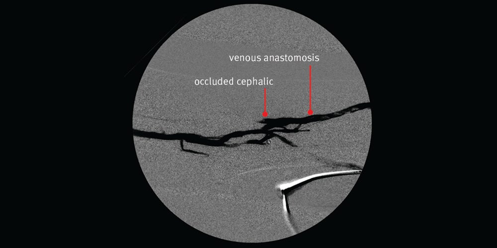 Angiogram