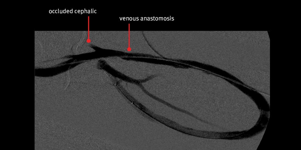 Angiogram