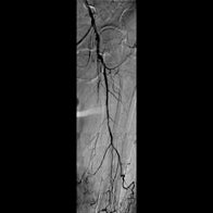 Non-healing ulcer with SFA disease 