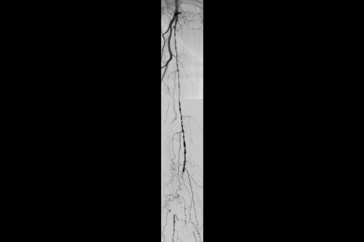 Angiogram