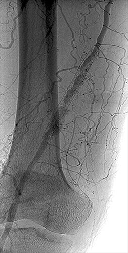 Before: Angiogram shows femoral atherectomy7