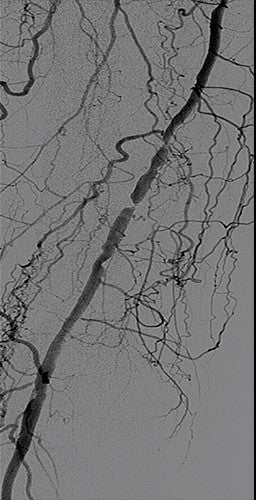 Angiogram