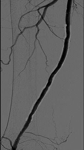 Angiogram showing result" loading