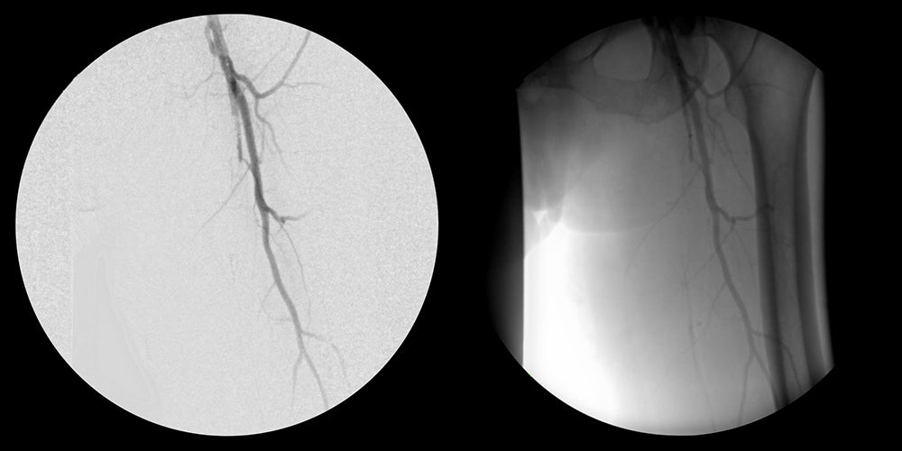 Severe peripheral arterial disease (PAD)" 