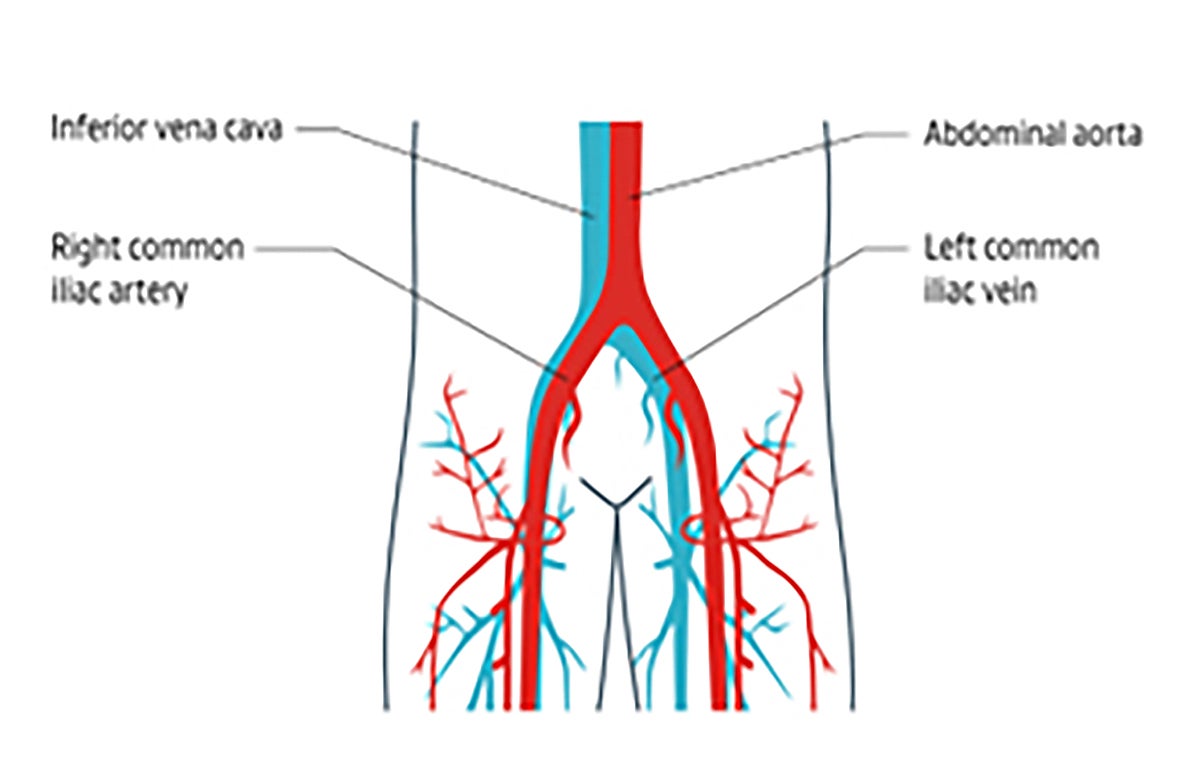 Anatomy image labeling the abdominal aorta, iliac vein, iliac artery and inferior vena cava.