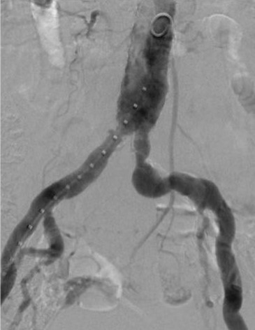 Achieving conformability and durable results in tortuous anatomy