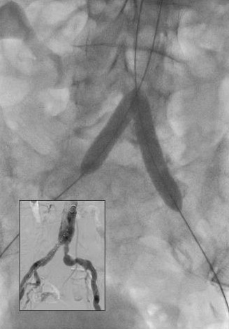 Achieving conformability and durable results in tortuous anatomy loading