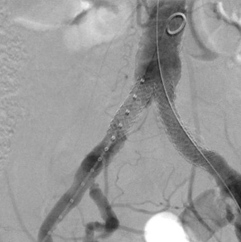 Widely patent arteries demonstrating VBX Stent Graft flexibility and radial strength in a highly tortuous vessel