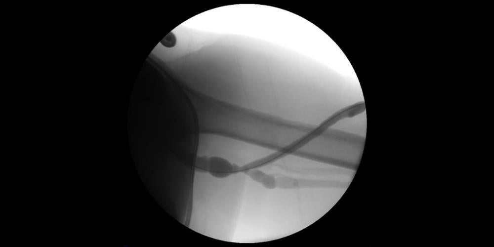 Fistulography with recurrent stenosis noted at venous outflow anastomosis.