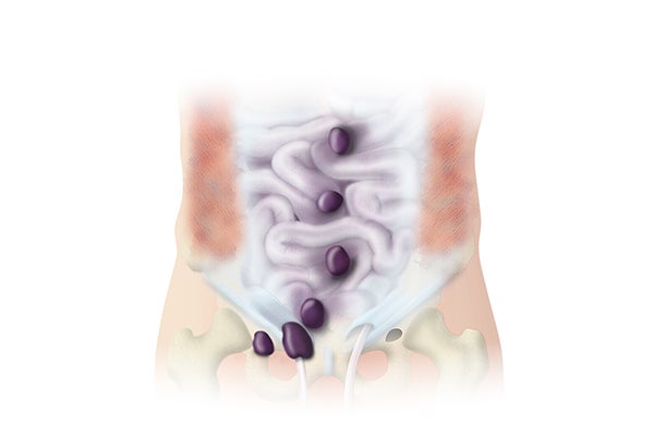 Hernia Where Hernias Occur 