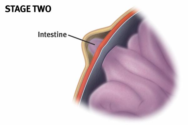 Intestine Pushes into the Sac 