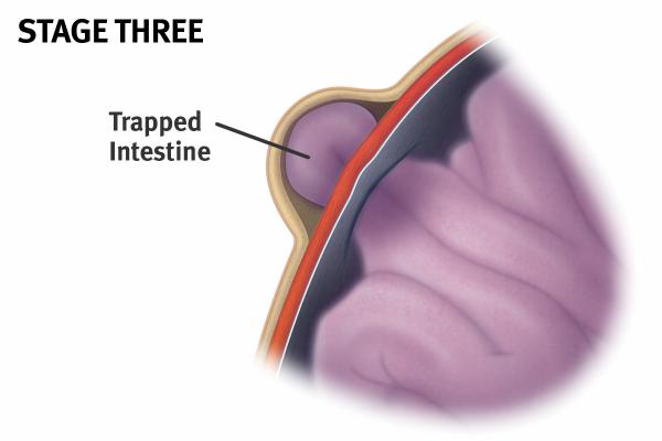 Intestine May Become Trapped 