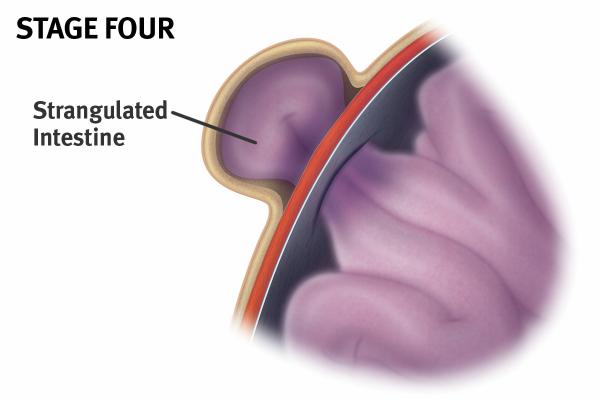 Intestine May Be Strangulated 