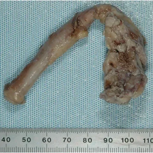 Femoral to posterior tibial bypass with polyester Linton patch