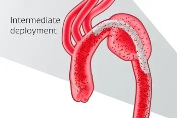 Promotes hemodynamic stability thumbnail