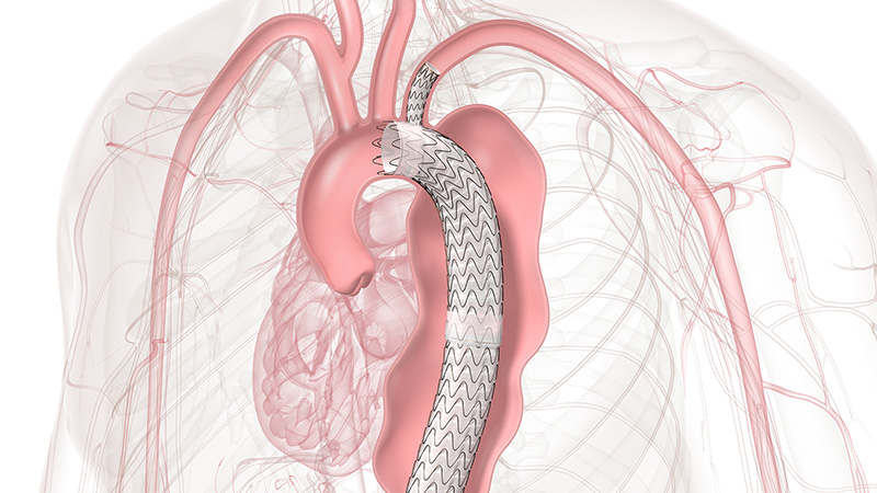 Diagram showing the anatomy of the aortic arch showing zone 2