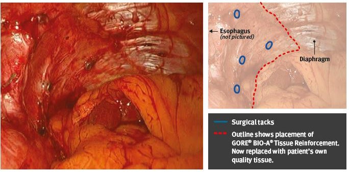 Eight-month post-op view of GORE® BIO-A® Tissue Reinforcement used for posterior suture-line reinforcement