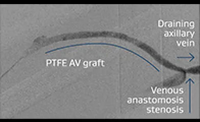 PTFE AV graft