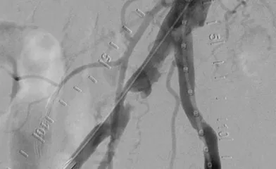 Focal calcification in the right CIA