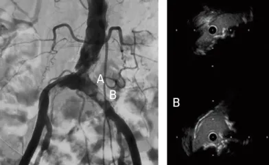 Calcified nodule at the aortoiliac bifurcation