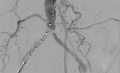 Figure 1. Aortoiliac occlusive disease at aortic bifurcation.