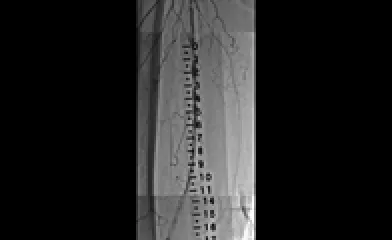 Diffuse in-stent restenosis in long-stented segment in the SFA