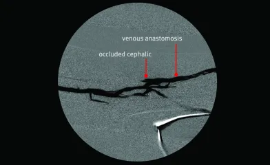 Angiogram