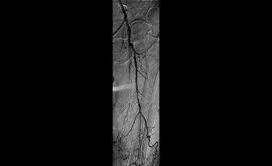 Angiogram