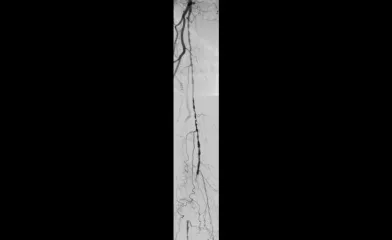 Angiogram