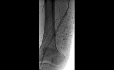 Before: Angiogram shows femoral atherectomy 7 