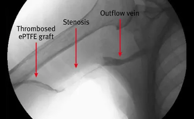 Venous anastomosis stenosis with thrombosis