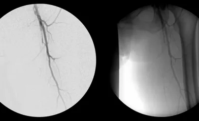 Severe peripheral arterial disease (PAD)" 