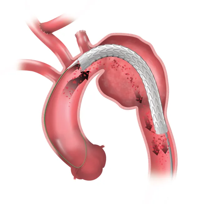 Illustration showing how “windsocking” is minimized during a TEVAR procedure using the TAG® Conformable Device