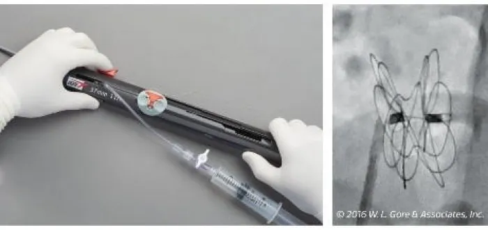 close up of gore cardioform asd occluder setting up for deployment