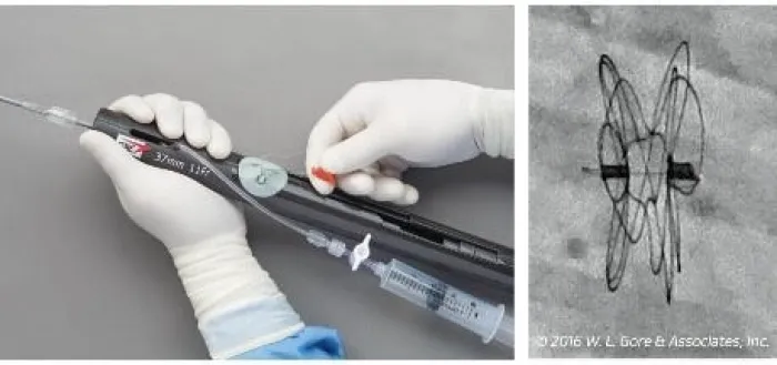 close up of gore cardioform asd occluder showing release function