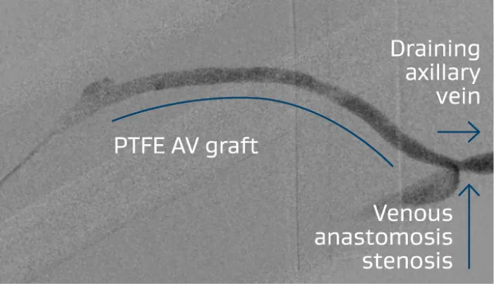 Right brachialaxillary AV graft with stenosis at the venous anastomosis 