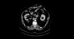 ENFORM device in complex abdominal wall reconstruction and bilateral transversus abdominis release (TAR) procedure.