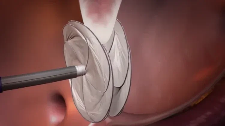 GORE® CARDIOFORM Septal Occluder Animation Video - PFO thumbnail