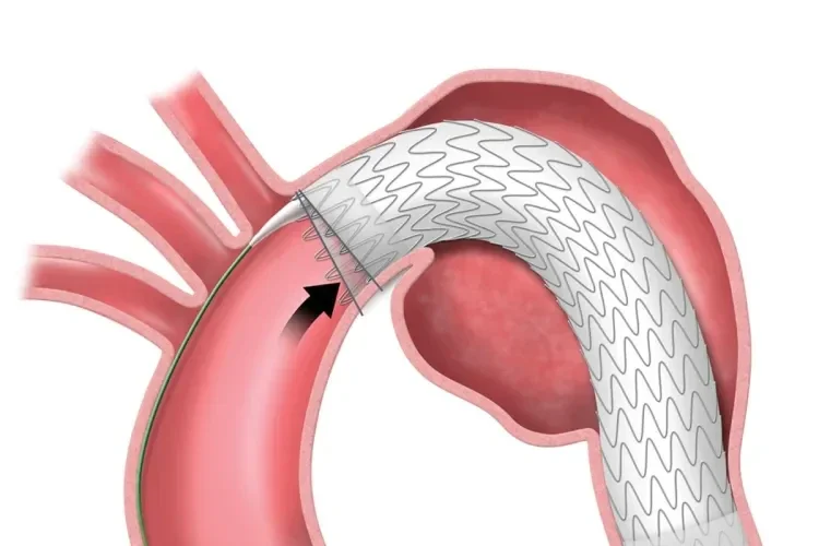 The delivery system provides two opportunities to adjust angulation as needed.